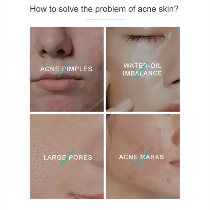Cel mai bun ser anti imbatranire pentru acnee pielii predispuse